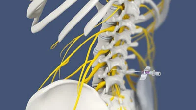 Nerve Blocks & Ablation