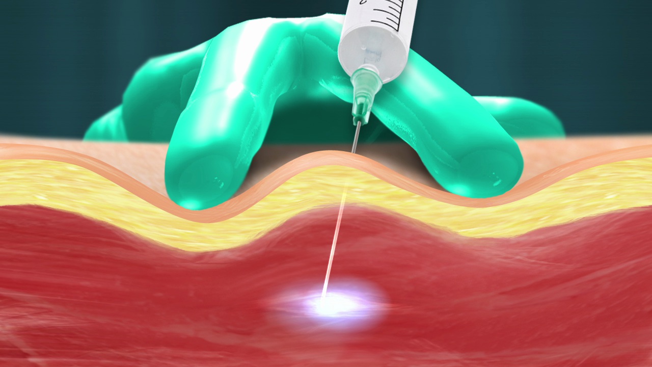 Spasticity Management